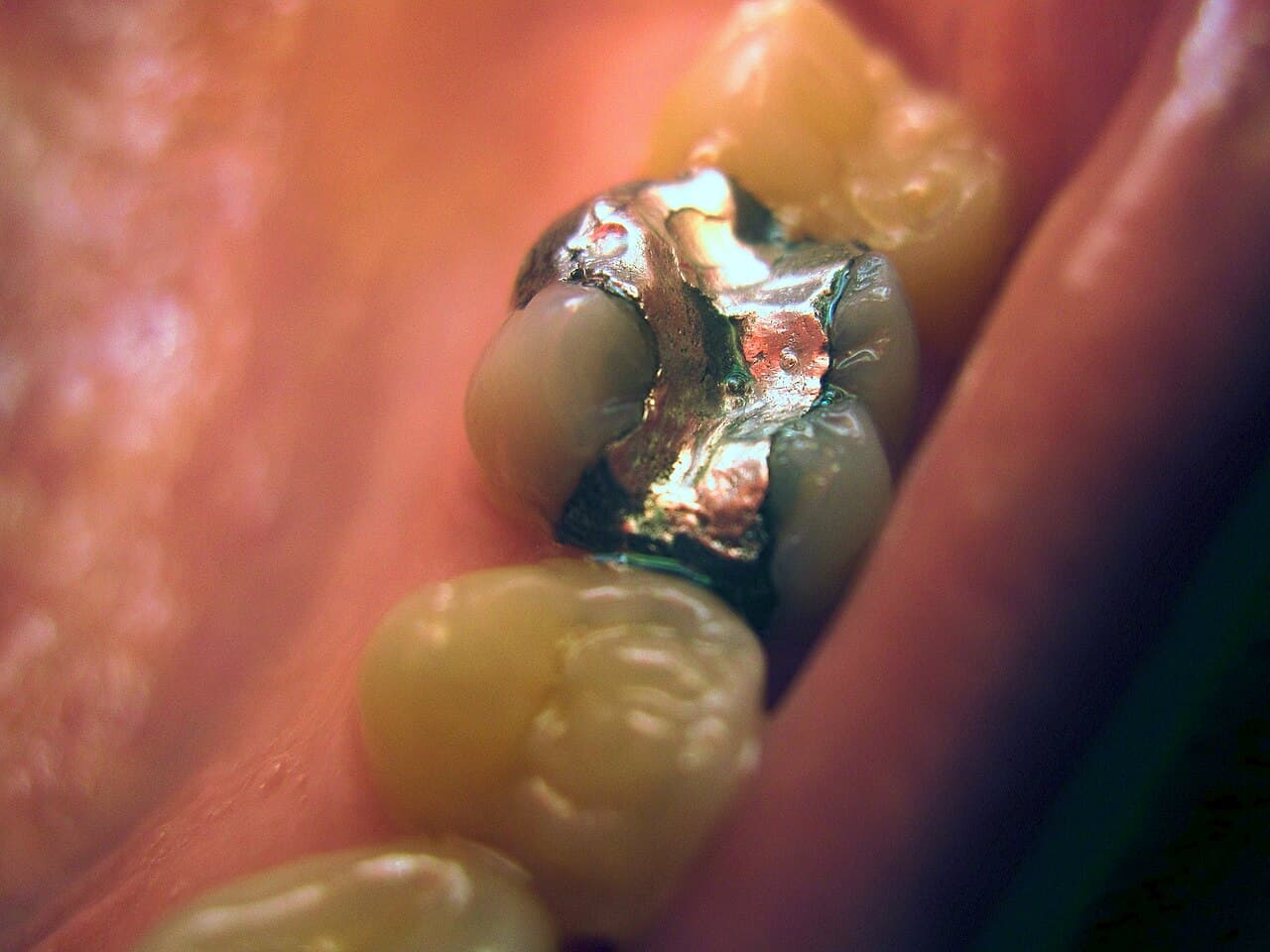 Close-up of a tooth showing a dental filling