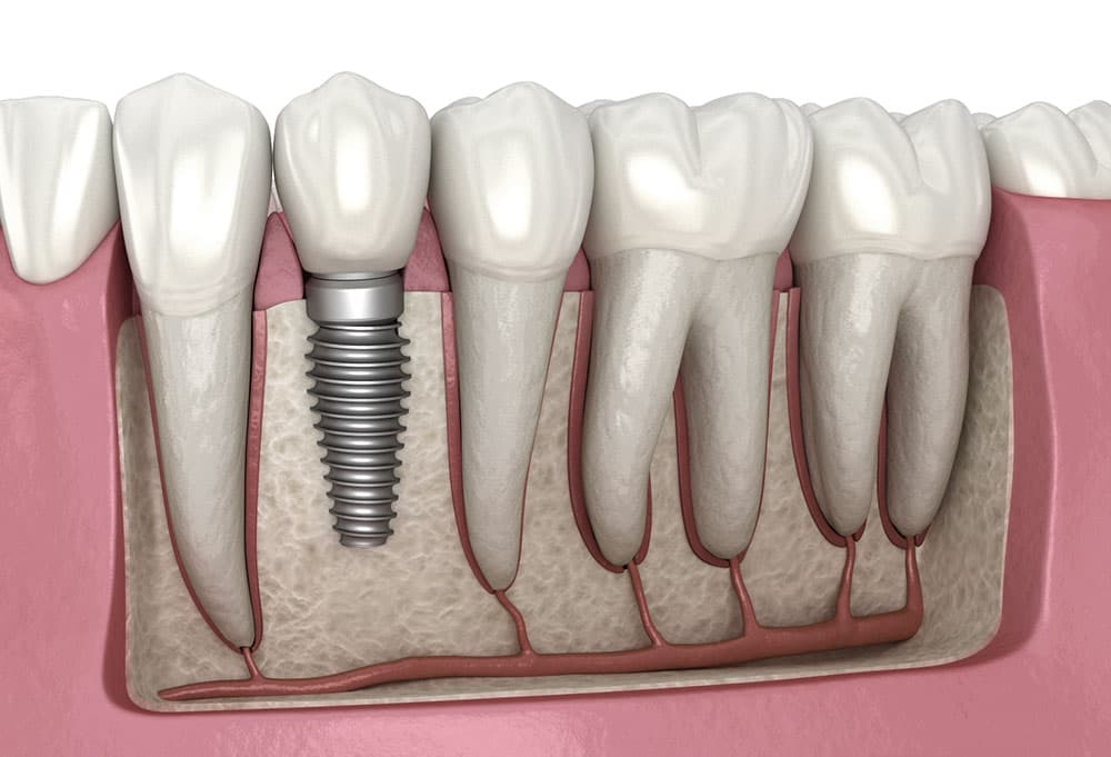 Diagram of a dental implant showing the titanium screw, abutment, and ceramic crown